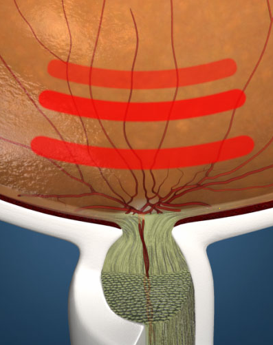 prueva de provocacion de glaucoma