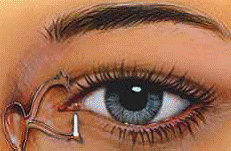 cirugia ojo seco