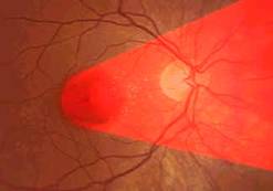 laser en retina