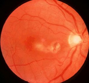 toxoplasmosis en retina