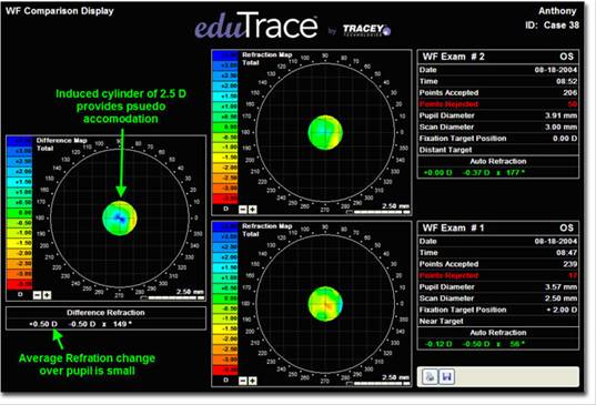 Wavefront Comparison Display: Accommodative IOL