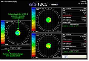 cirugia refractiva