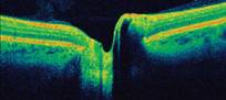 tomografia optica coherente oct nervio optico
