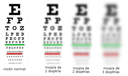 miopie minus 3 5 viziunea poate fi vindecată astigmatismul