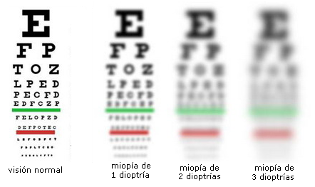Rövidlátás (myopia)