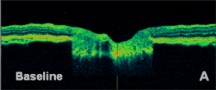 oct glaucoma