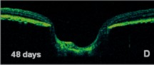 tomografia glaucoma