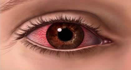ojo rojo