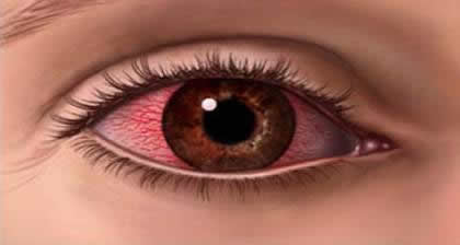 ojo rojo