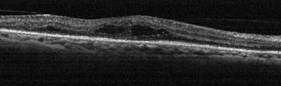 tomografia optica coherente oct edema macular diabetico