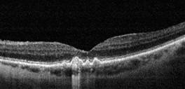 tomografia optica coherente oct drusas