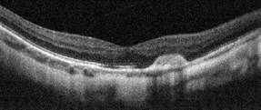 tomografia optica coerente oct