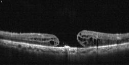 tomografia optica coherente agujero macular