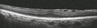 tomografia optica coherente membrana epiretiniana