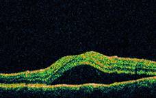 tomografia optica coherente retinopatia central serosa