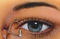 cirugia ojo seco